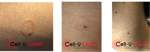 Before and After Pictures of Laser Therapy Patient
